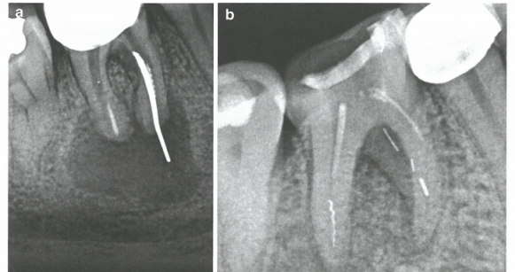 牙齒根管內顯微鏡下取斷針-根管內分離器械處理