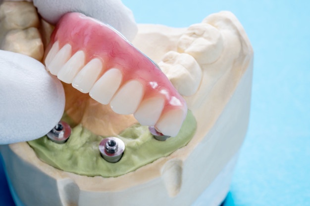 種牙齒的全部過程親身經歷！比想象的可怕