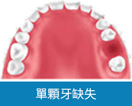 深圳種牙推薦