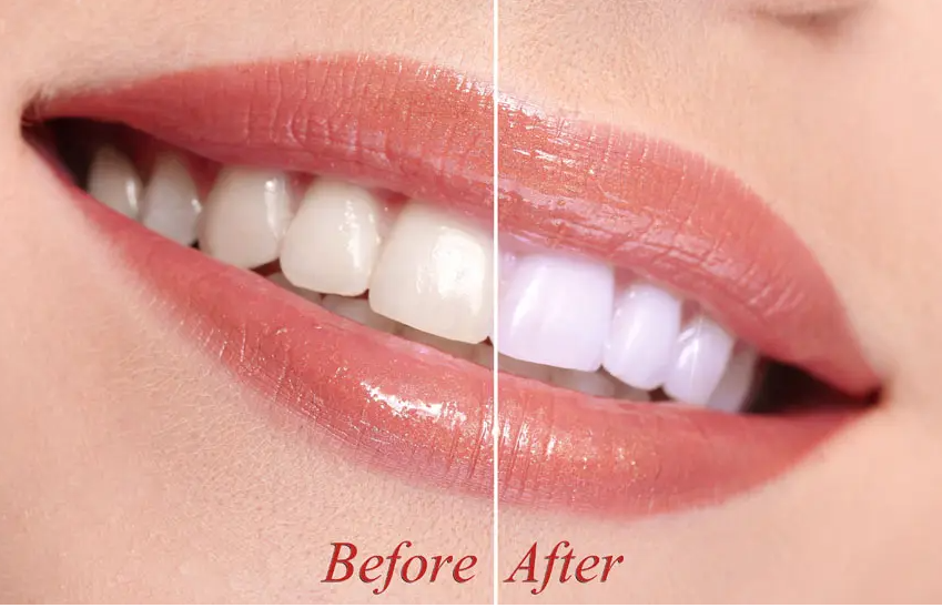 牙齒矯正+美白直接提升10點顏值,早知道這麼好就該早做