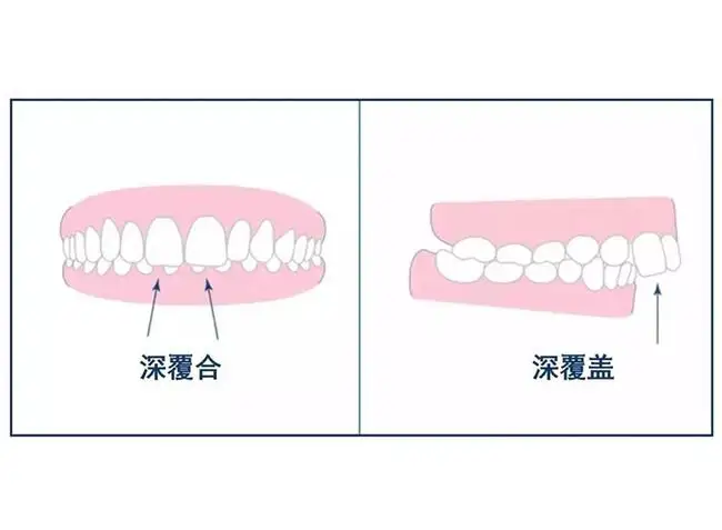 骨性深覆合牙齒矯正 拔牙4顆打骨釘6枚