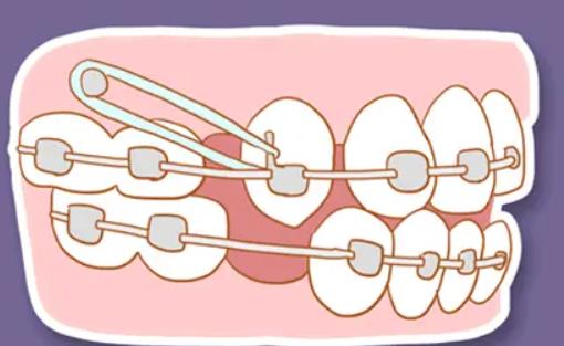 牙齒矯正千萬不要拖