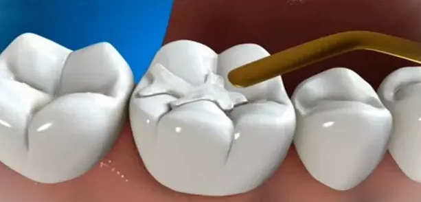 補牙會不會疼？