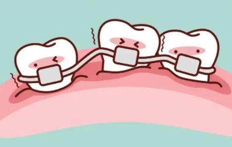 補牙後一般能使用幾年