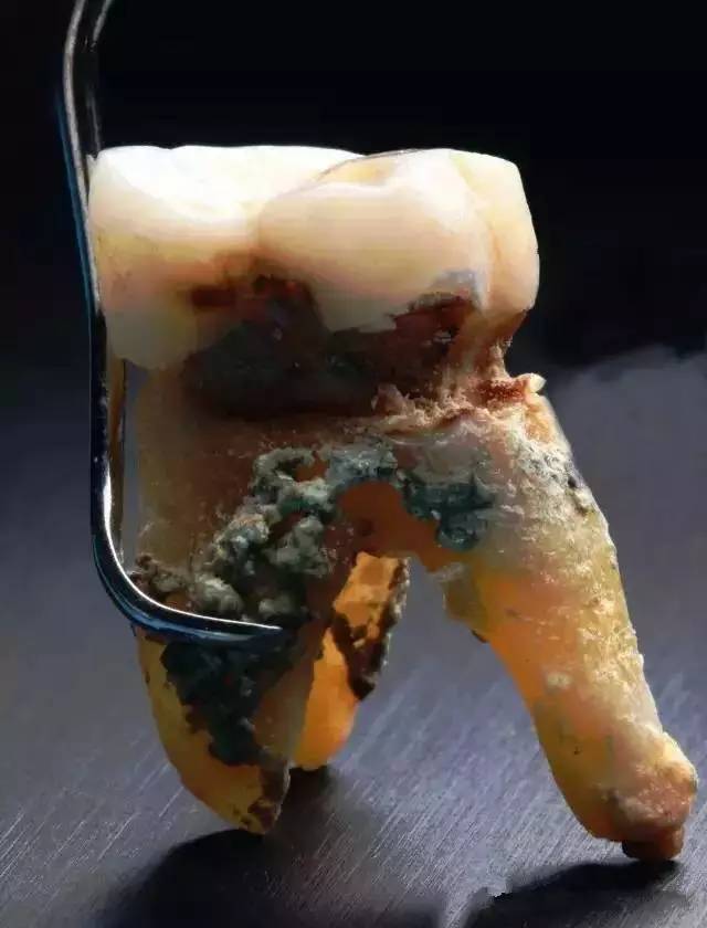 香港牙醫畀自然脫落嘅牙齒拍微距照片！有牙結石點辦