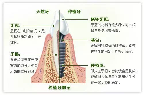 深圳種植牙，可以用一輩子咩？有人咁回答！