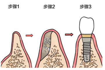 骨量不足還能種牙嗎？深圳全口植牙