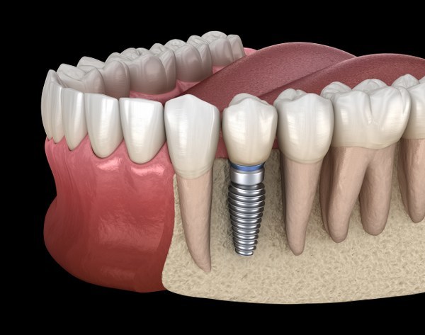 種植牙是否可以修復牙齒咬合的不正常位置？