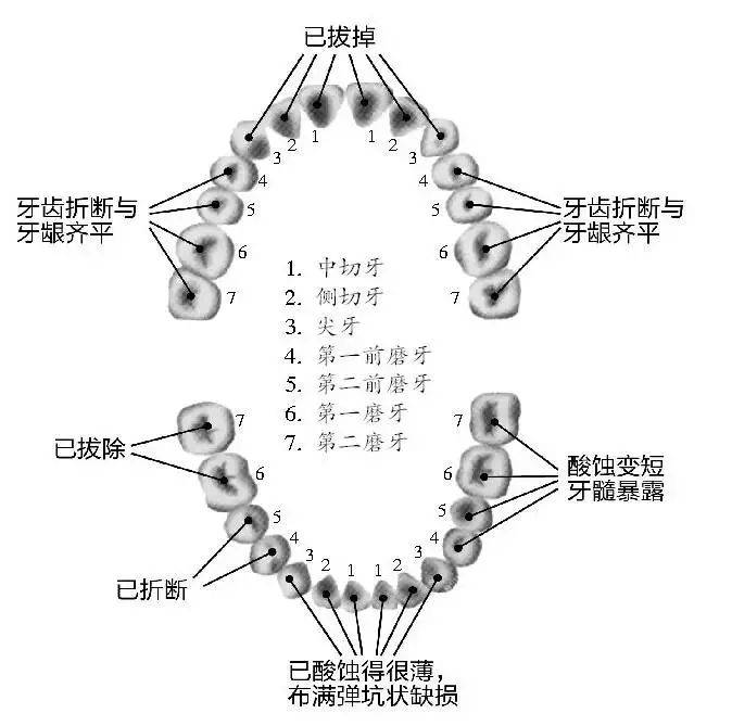 19歲高中生一口牙齒拔掉8顆，折斷10顆，這個習慣說不定你也有！可樂牙的危害