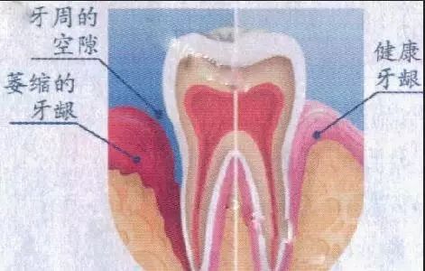 牙齒睇落似長咗？原來係牙齦縮咗！