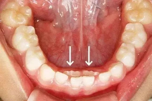 如果孩子嘅牙齒長咗雙排，應該點做呢？
