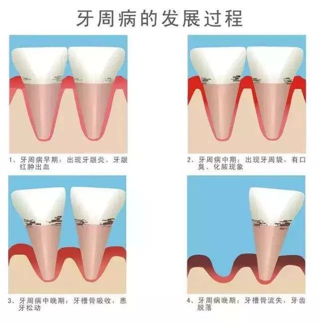 明明自己早晚堅持刷牙，點解仲會患上牙周炎呢