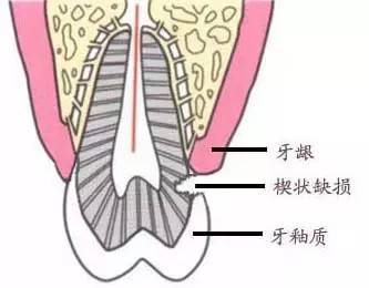 可怕！牙醫：你哋呢唔係在刷牙，而係喺「鋸牙」！