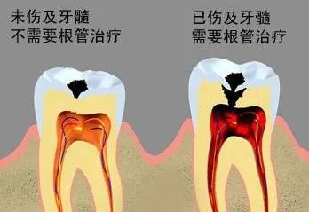 補牙唔做冠，療效減少一半！根管治療後牙齒已經唔痛，點解仲要戴牙冠呢？