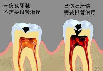 補牙唔做冠，療效少一半！根管治療後牙齒已經唔疼左，點解還要戴牙冠呢？