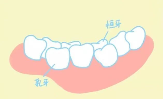 健康在線——關注牙健康，避免“雙排牙”