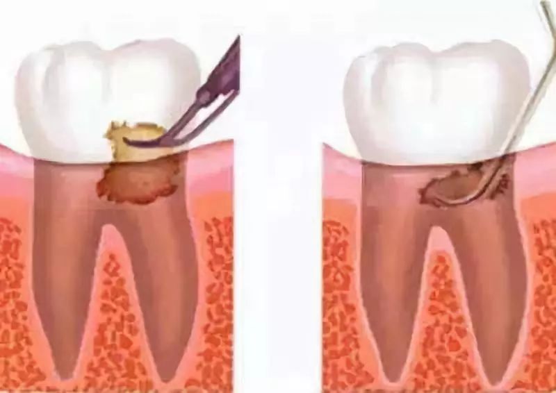 九個口腔常識竟然能讓牙齒患病率降低95%！
