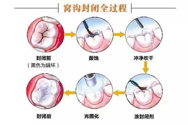 牙齒從針眼大的洞到拔除，步步驚心！