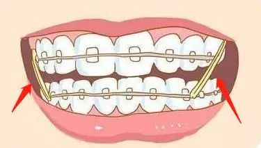 牙齒矯正時戴嘅小皮筋有咩用？