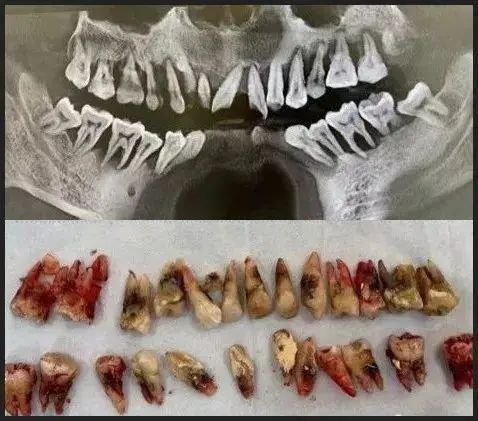 30多歲嘅小夥子因牙齒松動就診結果全口牙齒都要拔掉……