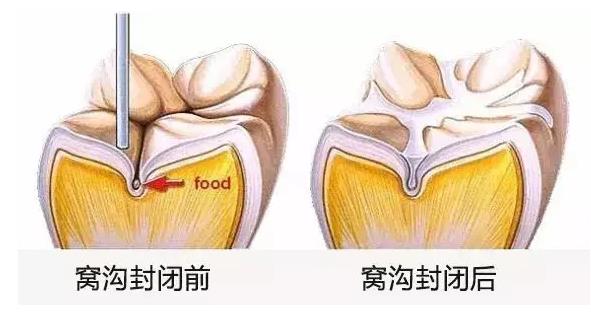 畀寶寶做窩溝封閉嘅4個最佳時機，錯過了小心孩子苦一輩子！深圳窩溝封閉