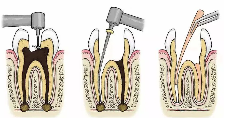 點解根管治療需要多次就診？深圳杜牙根