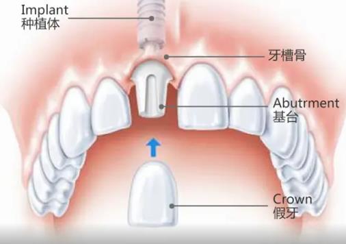 種植牙會影響周圍的牙齒嗎？