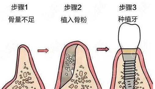 種植牙的成功率是多少？