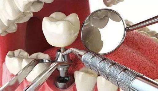 拔了六齡牙，種牙和鑲牙選擇哪一個更好？