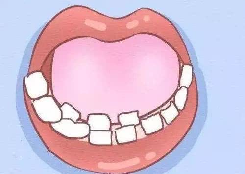 孩子在換牙期出現了影響顏值發育的“雙排牙”