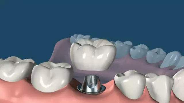 種植牙術后要如何護理？