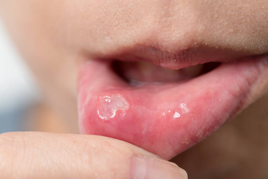 口腔為什麼總潰瘍？