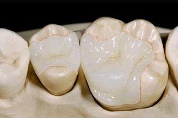 補牙后的牙齒不適，是否正常?