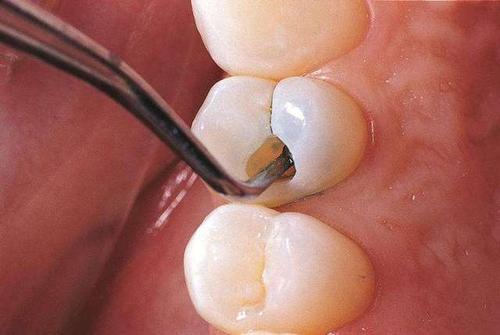 牙齒表面掉渣了怎麼辦？