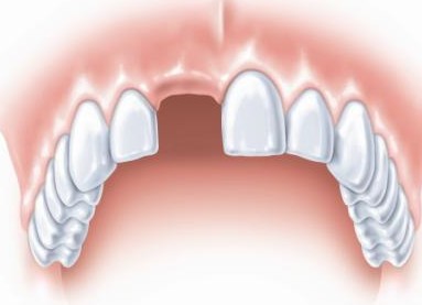 牙齒缺失 怎麼辦！