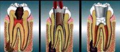 杜牙根治療全流程介紹