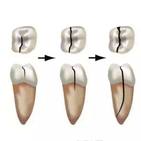 杜牙根後牙齒崩裂