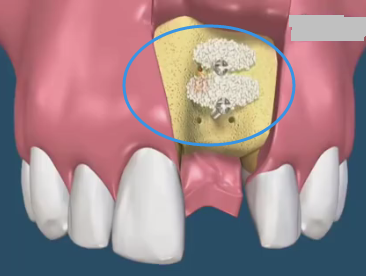 種牙加骨膜骨粉