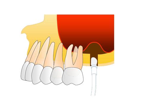 上頜竇提升術