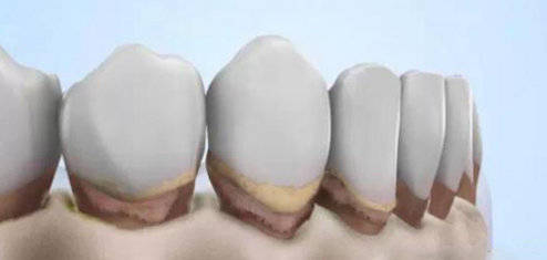 牙齦萎縮治療