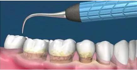 基礎牙周治療