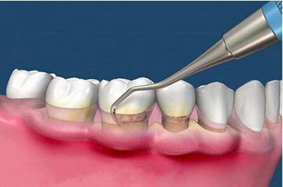 牙周刮治