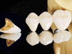 烤瓷牙對牙齒有冇影響？使用壽命有幾長？