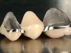 鎳鉻烤瓷牙是否需要拆除重做？