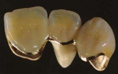 烤瓷牙導致牙齦發炎是什麼原因？