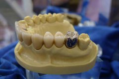 牙醫介紹影響烤瓷牙壽命的因素