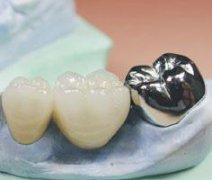 烤瓷牙修復體用鎳鉻合金的生物安全性