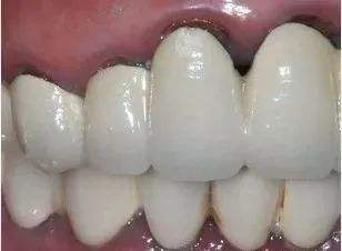 烤瓷牙牙齦黑線