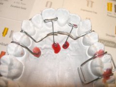 牙齒矯正種類有哪些呢？