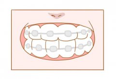 兒童牙齒矯正的關鍵